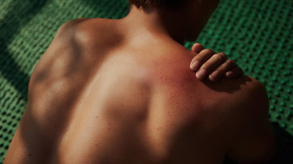 Zbliżenie na plecy mężczyzny – widać lekkie zaczerwienienie skóry